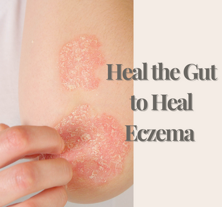 Heal the Gut to Heal Eczema