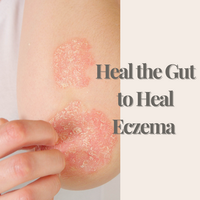 articles/Heal_the_Gut_to_Heal_Eczema_520x500_ab06ec17-f0d1-43b4-9302-955cbbe8aee4.png